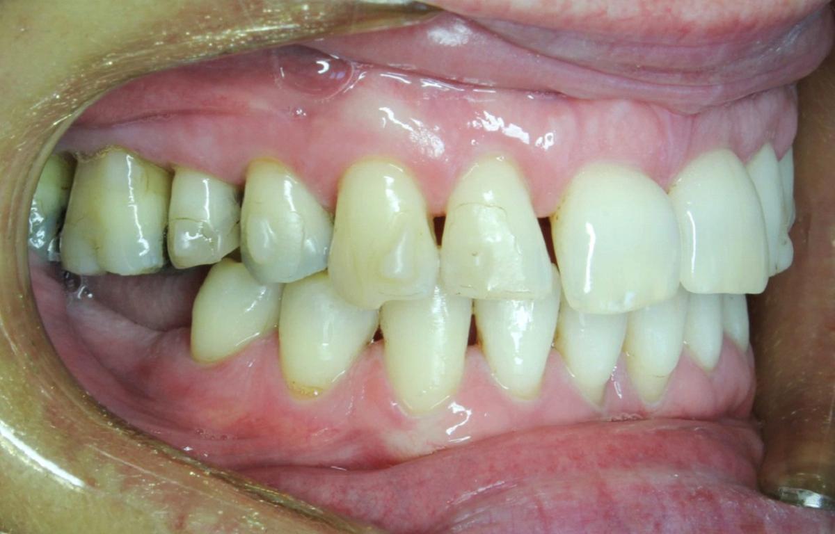 7 typov úsmevov, ktoré ľahko zachráni zubný strojček INVISALIGN. Ktorý je ten váš? 