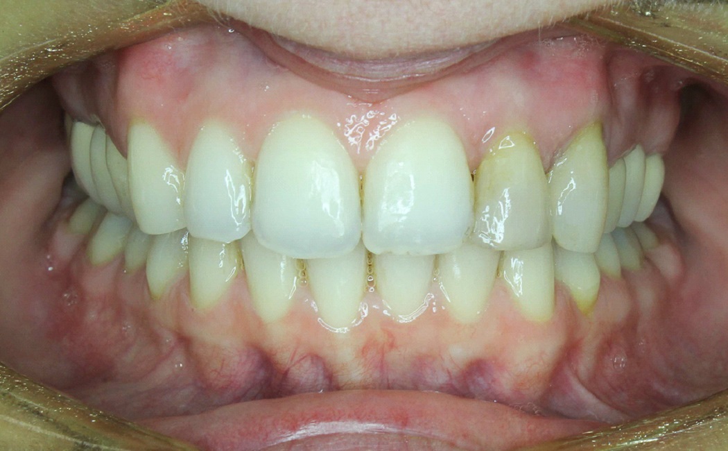 7 typov úsmevov, ktoré ľahko zachráni zubný strojček INVISALIGN. Ktorý je ten váš? 