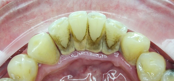 Ako mať zdravé a biele zuby po celý život - dentálna hygiena