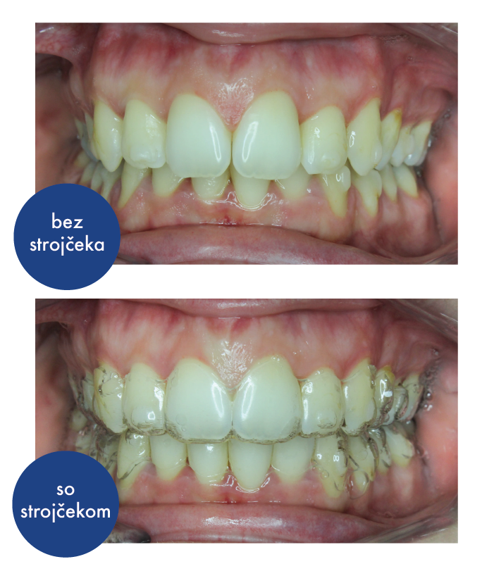 4 dôvody, prečo neviditeľný strojček vyhráva nad klasickým