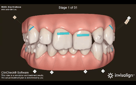 7 krokov ku krásnemu úsmevu s neviditeľným strojčekom