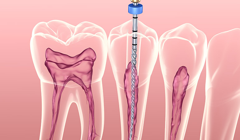 Endodoncia